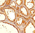 IHC staining of human thyroid tissue with Thyroglobulin antibody (clone 6E1).