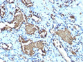 IHC testing of FFPE human angiosarcoma with recombinant Glycophorin A antibody (clone GYPA/1725R). Required HIER: boil tissue sections in pH 9 10mM Tris with 1mM EDTA for 10-20 min.