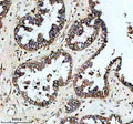 Immunohistochemical staining of PLIN5 using anti-PLIN5 antibody. PLIN5 was detected in a paraffin-embedded section of human ovarian cancer tissue. Heat mediated antigen retrieval was performed in EDTA buffer (pH 8.0, epitope retrieval solution). The tissue section was blocked with 10% goat serum. The tissue section was then incubated with 2 ug/ml rabbit anti-PLIN5 antibody overnight at 4oC. Peroxidase Conjugated Goat Anti-rabbit IgG was used as secondary antibody and incubated for 30 min at 37oC.