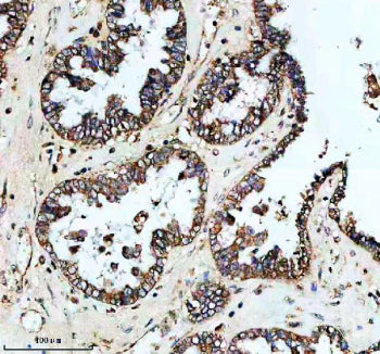 Immunohistochemical staining of PLIN5 using anti-PLIN5 antibody. PLIN5 was detected in a paraffin-embedded section of human ovarian cancer tissue. Heat mediated antigen retrieval was performed in EDTA buffer (pH 8.0, epitope retrieval solution). The tissue section was blocked with 10% goat serum. The tissue section was then incubated with 2 ug/ml rabbit anti-PLIN5 antibody overnight at 4oC. Peroxidase Conjugated Goat Anti-rabbit IgG was used as secondary antibody and incubated for 30 min at 37oC.