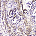 IHC testing of FFPE human prostate cancer with ATF4 antibody at 2ug/ml. HIER: boil tissue sections in pH6, 10mM citrate buffer, for 10-20 min followed by cooling at RT for 20 min.