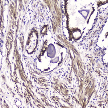 IHC testing of FFPE human prostate cancer with ATF4 antibody at 2ug/ml. HIER: boil tissue sections in pH6, 10mM citrate buffer, for 10-20 min followed by cooling at RT for 20 min.