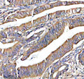 Immunohistochemical staining of NOXO1 using anti-NOXO1 antibody. NOXO1 was detected in a paraffin-embedded section of human prostate cancer tissue. Heat mediated antigen retrieval was performed in EDTA buffer (pH 8.0, epitope retrieval solution). The tissue section was blocked with 10% goat serum. The tissue section was then incubated with 2 ug/ml rabbit anti-NOXO1 antibody overnight at 4oC. Peroxidase Conjugated Goat Anti-rabbit IgG was used as secondary antibody and incubated for 30 min at 37oC.