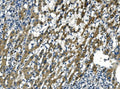 IHC staining of FFPE human liver cancer tissue with APLN antibody. HIER: boil tissue sections in pH8 EDTA for 20 min and allow to cool before testing.