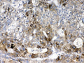 IHC testing of FFPE human liver cancer tissue with CYP2D6 antibody at 1ug/ml. Required HIER: steam section in pH6 citrate buffer for 20 min and allow to cool prior to testing.