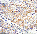 Immunohistochemical staining of FUNDC1 using anti-FUNDC1 antibody. FUNDC1 was detected in a paraffin-embedded section of human cervical cancer tissue. Heat mediated antigen retrieval was performed in EDTA buffer (pH 8.0, epitope retrieval solution). The tissue section was blocked with 10% goat serum. The tissue section was then incubated with 2 ug/ml rabbit anti-FUNDC1 antibody overnight at 4oC. Peroxidase Conjugated Goat Anti-rabbit IgG was used as secondary antibody and incubated for 30 min at 37oC.