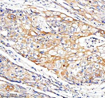 Immunohistochemical staining of FUNDC1 using anti-FUNDC1 antibody. FUNDC1 was detected in a paraffin-embedded section of human cervical cancer tissue. Heat mediated antigen retrieval was performed in EDTA buffer (pH 8.0, epitope retrieval solution). The tissue section was blocked with 10% goat serum. The tissue section was then incubated with 2 ug/ml rabbit anti-FUNDC1 antibody overnight at 4oC. Peroxidase Conjugated Goat Anti-rabbit IgG was used as secondary antibody and incubated for 30 min at 37oC.