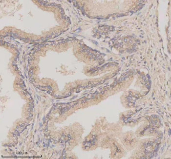 Immunohistochemical staining of TMEM175 using anti-TMEM175 antibody. TMEM175 was detected in a paraffin-embedded section of human prostate cancer tissue. Heat mediated antigen retrieval was performed in EDTA buffer (pH 8.0, epitope retrieval solution). The tissue section was blocked with 10% goat serum. The tissue section was then incubated with 2 ug/ml rabbit anti-TMEM175 antibody overnight at 4oC. Peroxidase Conjugated Goat Anti-rabbit IgG was used as secondary antibody and incubated for 30 min at 37oC.