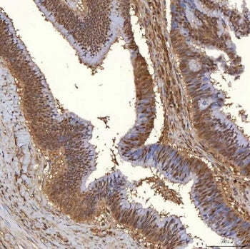 IHC staining of FFPE human colon adenocarcinoma tissue with PIG3 antibody. HIER: boil tissue sections in pH8 EDTA for 20 min and allow to cool before testing.
