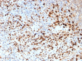 IHC staining of FFPE human cervix with recombinant HSV1 antibody (clone HSV1/1934). Required HIER: boil tissue sections in pH6, 10mM citrate buffer, for 10-20 min followed by cooling at RT for 20 min.