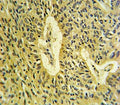 SMAD7 antibody IHC analysis in formalin fixed and paraffin embedded lung carcinoma.