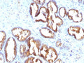 IHC staining of FFPE human prostate carcinoma with PSAP antibody (clone PASE/4LJ). HIER: boil tissue sections in pH 9 10mM Tris with 1mM EDTA for 20 min and allow to cool before testing.