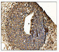 IHC staining of FFPE human liver cancer tissue with Antizyme inhibitor 2 antibody. HIER: boil tissue sections in pH8 EDTA for 20 min and allow to cool before testing.