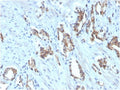 IHC staining of FFPE human prostate carcinoma with biotinylated TIGIT antibody. HIER: boil tissue sections in pH 9 10mM Tris with 1mM EDTA for 20 min and allow to cool before testing.