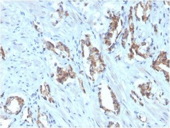 IHC staining of FFPE human prostate carcinoma with biotinylated TIGIT antibody. HIER: boil tissue sections in pH 9 10mM Tris with 1mM EDTA for 20 min and allow to cool before testing.