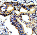 Immunohistochemical staining of REST using anti-REST antibody. REST was detected in a paraffin-embedded section of human thyroid cancer tissue. Heat mediated antigen retrieval was performed in EDTA buffer (pH 8.0, epitope retrieval solution). The tissue section was blocked with 10% goat serum. The tissue section was then incubated with 2 ug/ml rabbit anti-REST antibody overnight at 4oC. Peroxidase Conjugated Goat Anti-rabbit IgG was used as secondary antibody and incubated for 30 min at 37oC.