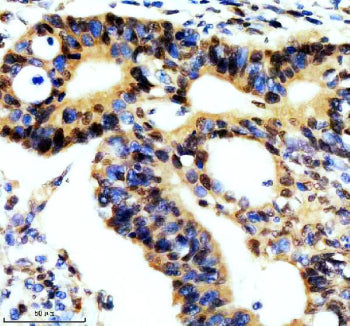Immunohistochemical staining of REST using anti-REST antibody. REST was detected in a paraffin-embedded section of human thyroid cancer tissue. Heat mediated antigen retrieval was performed in EDTA buffer (pH 8.0, epitope retrieval solution). The tissue section was blocked with 10% goat serum. The tissue section was then incubated with 2 ug/ml rabbit anti-REST antibody overnight at 4oC. Peroxidase Conjugated Goat Anti-rabbit IgG was used as secondary antibody and incubated for 30 min at 37oC.
