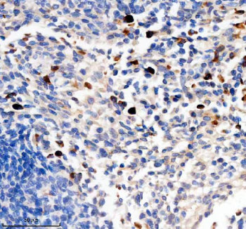Immunohistochemical staining of TCIRG1 using anti-TCIRG1 antibody. TCIRG1 was detected in a paraffin-embedded section of human lung cancer tissue. Heat mediated antigen retrieval was performed in EDTA buffer (pH 8.0, epitope retrieval solution). The tissue section was blocked with 10% goat serum. The tissue section was then incubated with 2 ug/ml rabbit anti-TCIRG1 antibody overnight at 4oC. Peroxidase Conjugated Goat Anti-rabbit IgG was used as secondary antibody and incubated for 30 min at 37oC.