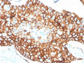 IHC staining of FFPE human breast carcinoma tissue with recombinant ErbB2 antibody (clone ERBB2/4376R) at 2ug/ml in PBS for 30min RT. HIER: boil tissue sections in pH 9 10mM Tris with 1mM EDTA for 20 min and allow to cool before testing.