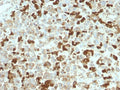 IHC testing of FFPE human melanoma tissue with recombinant NGFR antibody. Required HIER: boil tissue sections in pH6, 10mM citrate buffer, for 10-20 min and allow to cool prior to testing.