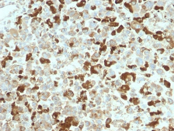 IHC testing of FFPE human melanoma tissue with recombinant NGFR antibody. Required HIER: boil tissue sections in pH6, 10mM citrate buffer, for 10-20 min and allow to cool prior to testing.