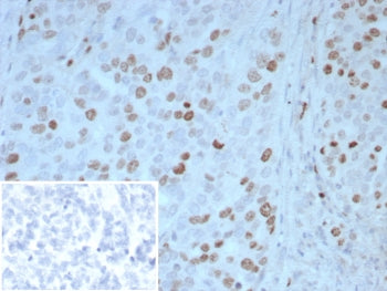 IHC staining of FFPE human ovarian carcinoma tissue with PAX4 antibody (clone PAX4/7598). Inset: PBS used in place of primary Ab (secondary Ab negative control). HIER: boil tissue sections in pH 9 10mM Tris with 1mM EDTA for 20 min and allow to cool before testing.