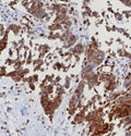 IHC staining of FFPE human serous ovarian carcinoma with ERIS antibody (clone STING1/8187R). HIER: boil tissue sections in pH 9 10mM Tris with 1mM EDTA for 20 min and allow to cool before testing.