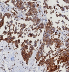 IHC staining of FFPE human serous ovarian carcinoma with ERIS antibody (clone STING1/8187R). HIER: boil tissue sections in pH 9 10mM Tris with 1mM EDTA for 20 min and allow to cool before testing.