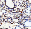 Immunohistochemical staining of TRIM32 using anti-TRIM32 antibody. TRIM32 was detected in a paraffin-embedded section of human thyroid cancer tissue. Heat mediated antigen retrieval was performed in EDTA buffer (pH 8.0, epitope retrieval solution). The tissue section was blocked with 10% goat serum. The tissue section was then incubated with 2 ug/ml rabbit anti-TRIM32 antibody overnight at 4oC. Peroxidase Conjugated Goat Anti-rabbit IgG was used as secondary antibody and incubated for 30 min at 37oC.
