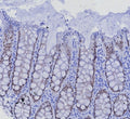 IHC staining of FFPE human colon carcinoma tissue with SATB2 antibody (clone SATB2/7488) at 2ug/ml. Inset: PBS used in place of primary Ab (secondary Ab negative control). HIER: boil tissue sections in pH 9 10mM Tris with 1mM EDTA for 20 min and allow to cool before testing.