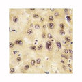 IHC analysis of FFPE human hepatocarcinoma tissue stained with PROX1 antibody