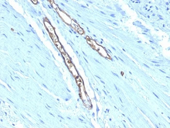 IHC: Formalin-fixed, paraffin-embedded human colon carcinoma stained with Blood Group Antigen A antibody (HE-193)