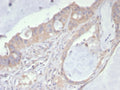 IHC staining of FFPE human colon cancer tissue with PDGFRA antibody (clone PDGFRA/7407). HIER: boil tissue sections in pH 9 10mM Tris with 1mM EDTA for 20 min and allow to cool before testing.