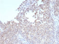 IHC staining of FFPE human bladder tissue with recombinant Estrogen Receptor beta 1 antibody (clone ESR2/9251R). HIER: boil tissue sections in pH 9 10mM Tris with 1mM EDTA for 20 min and allow to cool before testing.