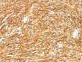 IHC testing of FFPE human gastrointestinal stromal tumor (GIST) with DOG1 antibody (DG1/1485). Required HIER: boil tissue sections in pH 9 10mM Tris with 1mM EDTA for 10-20 min.
