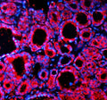 Immunofluorescent staining of SPOCK1 using anti-SPOCK1 antibody (red). SPOCK1 was detected in a paraffin-embedded section of human thyroid cancer tissue. Heat mediated antigen retrieval was performed in EDTA buffer (pH 8.0, epitope retrieval solution). The tissue section was blocked with 10% goat serum. The tissue section was then incubated with 5 ug/ml rabbit anti-SPOCK1 antibody overnight at 4oC.
