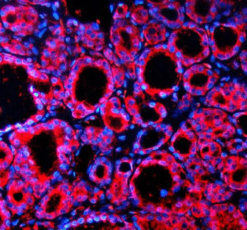 Immunofluorescent staining of SPOCK1 using anti-SPOCK1 antibody (red). SPOCK1 was detected in a paraffin-embedded section of human thyroid cancer tissue. Heat mediated antigen retrieval was performed in EDTA buffer (pH 8.0, epitope retrieval solution). The tissue section was blocked with 10% goat serum. The tissue section was then incubated with 5 ug/ml rabbit anti-SPOCK1 antibody overnight at 4oC.
