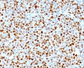 IHC: Formalin-fixed, paraffin-embedded human mantle cell lymphoma stained with CCND1 antibody.