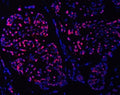Immunofluorescent staining of FFPE human breast cancer tissue with SMC6 antibody (red) and DAPI nuclear stain (blue). HIER: steam section in pH8 EDTA buffer for 20 min.