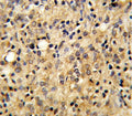IHC testing of FFPE human prostate carcinoma tissue with TSP5 antibody. HIER: steam section in pH6 citrate buffer for 20 min and allow to cool prior to staining.