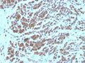 IHC staining of FFPE human breast carcinoma tissue with NME2 antibody (clone NME2/6435). HIER: boil tissue sections in pH 9 10mM Tris with 1mM EDTA for 20 min and allow to cool before testing.
