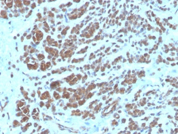 IHC staining of FFPE human breast carcinoma tissue with NME2 antibody (clone NME2/6435). HIER: boil tissue sections in pH 9 10mM Tris with 1mM EDTA for 20 min and allow to cool before testing.