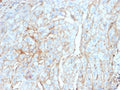 IHC testing of FFPE cervical carcinoma with PD-L1 antibody (clone PDL1/2746). HIER: boil tissue sections in pH 9 10mM Tris with 1mM EDTA for 10-20 min followed by cooling at RT for 20 min.
