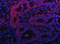 Immunofluorescent staining of FFPE human intestinal cancer tissue with Proteasome subunit beta type 9 antibody (red) and DAPI nuclear stain (blue). HIER: steam section in pH8 EDTA buffer for 20 min.