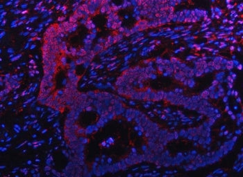 Immunofluorescent staining of FFPE human intestinal cancer tissue with Proteasome subunit beta type 9 antibody (red) and DAPI nuclear stain (blue). HIER: steam section in pH8 EDTA buffer for 20 min.