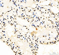 IHC staining of FFPE human renal cell carcinoma tissue with JUND antibody. HIER: boil tissue sections in pH8 EDTA for 20 min and allow to cool before testing.