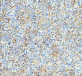 IHC staining of FFPE human glioma tissue with Aquaporin 4 antibody. HIER: boil tissue sections in pH8 EDTA for 20 min and allow to cool before testing.