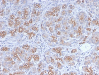 IHC staining of FFPE human breast carcinoma with recombinant Golgi antibody (clone GLG1/2829R). HIER: boil tissue sections in pH 9 10mM Tris with 1mM EDTA for 10-20 min and allow to cool before testing.
