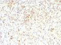 IHC staining of FFPE human liposarcoma tissue with recombinant MDM2 antibody (clone rMDM2/9214). HIER: boil tissue sections in pH 9 10mM Tris with 1mM EDTA for 20 min and allow to cool before testing.