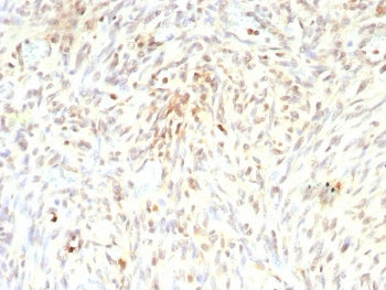 IHC staining of FFPE human liposarcoma tissue with recombinant MDM2 antibody (clone rMDM2/9214). HIER: boil tissue sections in pH 9 10mM Tris with 1mM EDTA for 20 min and allow to cool before testing.